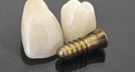 Implantat und Zahnersatz